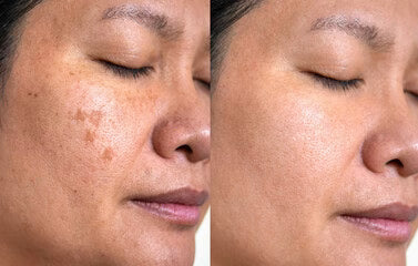 Corrector de Manchas Oscuras con Vitamina C – Rostro y Manos