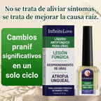 Líquido Antifúngico Uñas Tolnaftato 1% Tratamiento Hongos Manos y Pies 11ml