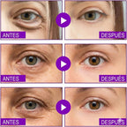 Parches de Microagujas 'MicroGlow' Infusionados con Retinol y Ácido Hialurónico para Rellenar Arrugas, Bolsas y Ojeras