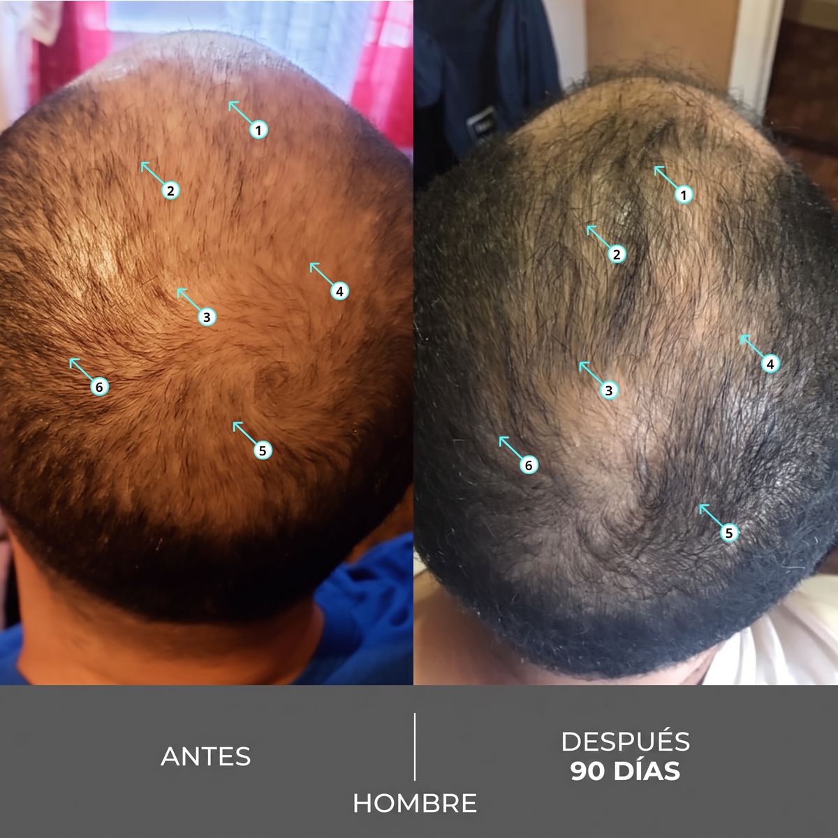 Shampoo Densificador Capilar Fuerza Extra con Nanoxidil 205ml